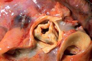 A stenotic aortic valve with severe stenosis due to rheumatic heart disease