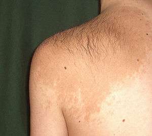 A large, light-tan colored patch of skin over an adult's left shoulder and upper back