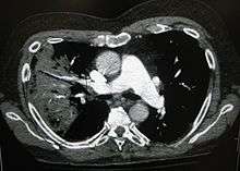 A black-and-white image shows the internal organs in cross-section as generated by CT. Where one would expect black on the left, one sees a whiter area with black sticks through it.