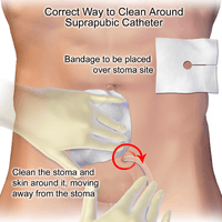 How to properly clean around a suprapubic catheter.