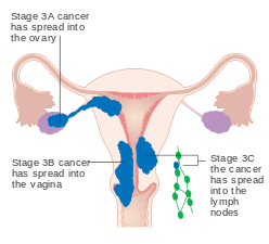 A diagram of stage III endometrial cancer