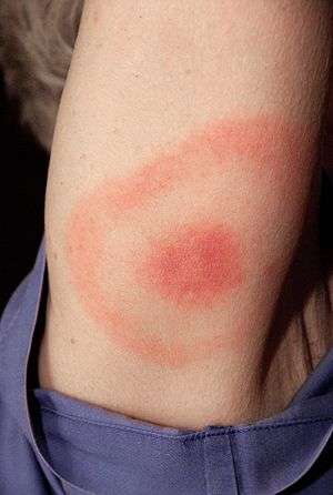 Large erythematous patch in the pattern of a "bull's-eye" on a woman's posterior upper arm