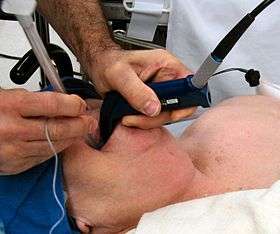 Photograph of an anesthesiologist using the Glidescope video laryngoscope to intubate the trachea of a morbidly obese elderly person with challenging airway anatomy