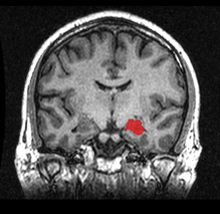 MRI coronal view of a hippocampus shown in red.