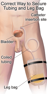 Correct way to secure the tubing and leg bag of a suprapubic catheter on a male.