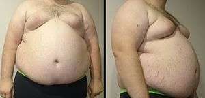 A front and side view of a "super obese" male torso. Stretch marks of the skin are visible along with gynecomastia.