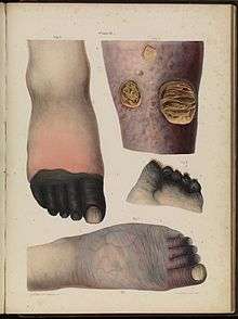 Four drawn illustrations on a page, including (top left) a foot with black toes, (top right) a limb with holes in the skin showing yellowed matter beneath, (centre right) the end of a foot with blackened stubs where the toes once were, and (bottom) a foot that is wrinkled and dark, with prominent veins and purple toes.