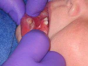 Solitary, large, white to yellow erosion on the inner lower lip of a child