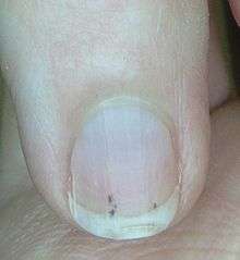 Small, linear, blue-black areas of discoloration beneath the nail plate of an adult finger
