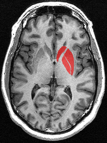 This is a transverse section of the striatum from a structural MR image. The striatum includes the caudate nucleus and putamen. The image also includes the globus pallidus, which is sometimes included when using the term corpus striatum.