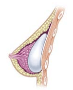 Subglandular breast implant diagram
