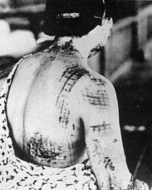 A woman's back, with chequered-shaped burns
