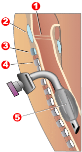 Diagram of a tracheostomy tube in the trachea